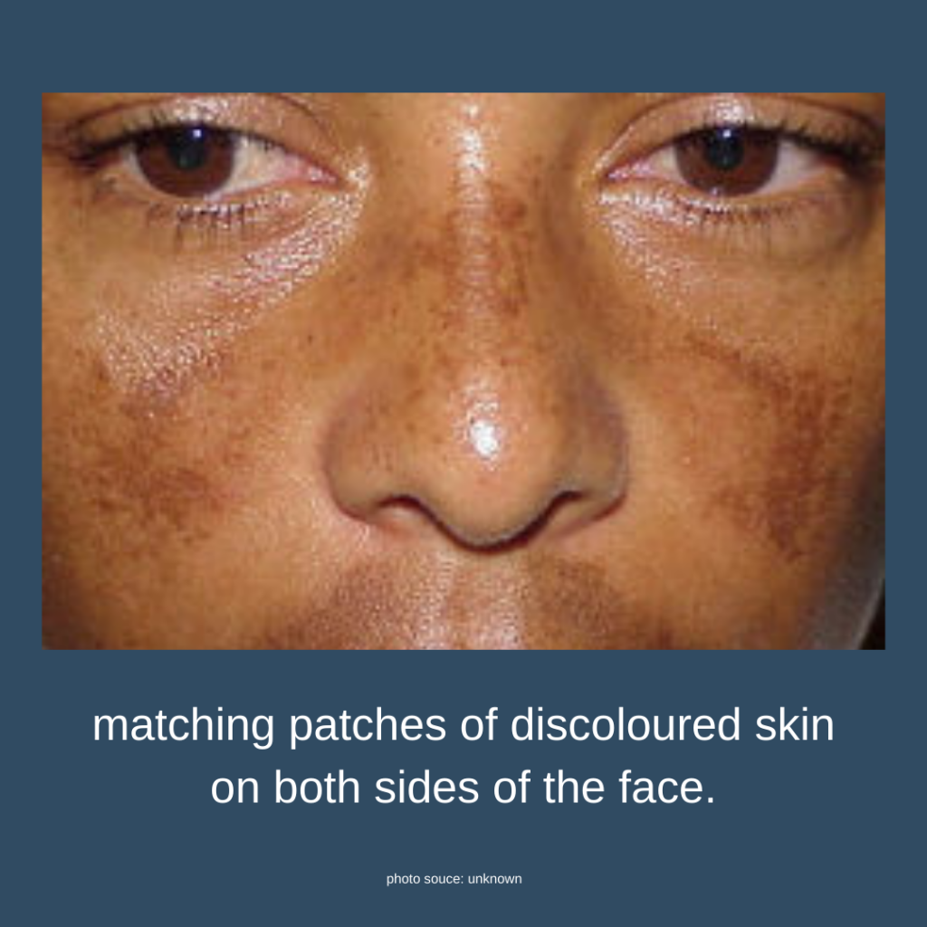 What Is The Difference Between Hyperpigmentation And Melasma North